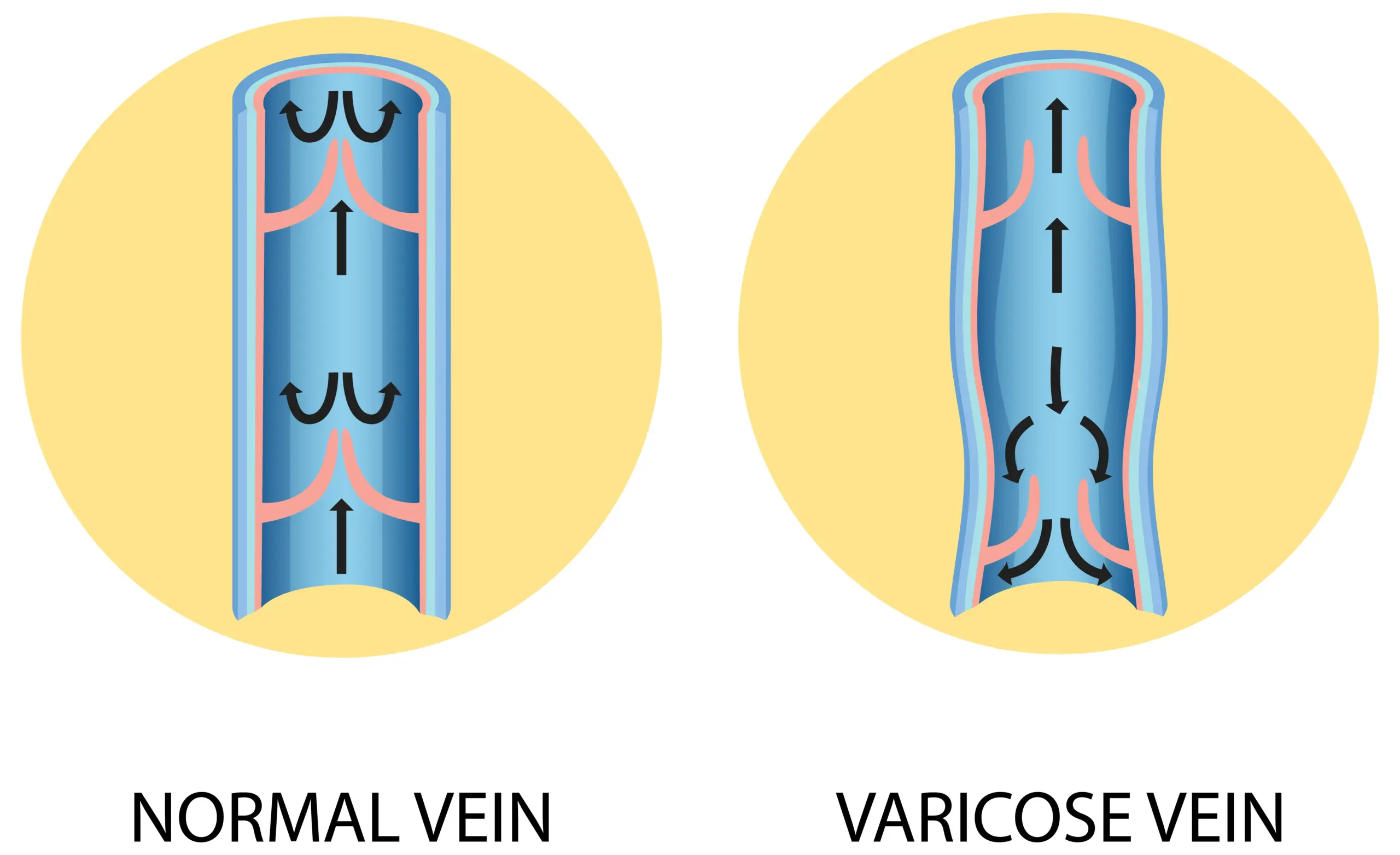 Essential Facts to Know: What Is Deep Veins and Why They Matter