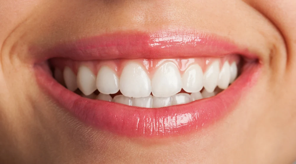 bonded teeth before and after