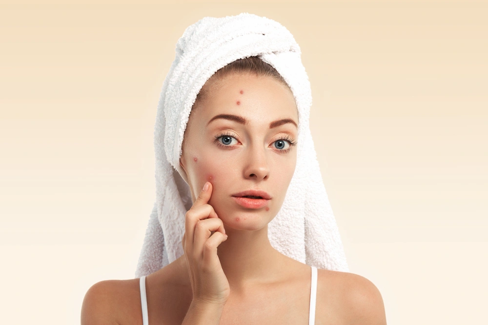 7 Proven Ways to Remove Pimples Naturally and Permanently: A Holistic Skincare Guide