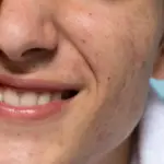 How to Get Rid of Tiny Bumps on Face Quickly: A Practical Guide to Clear Skin