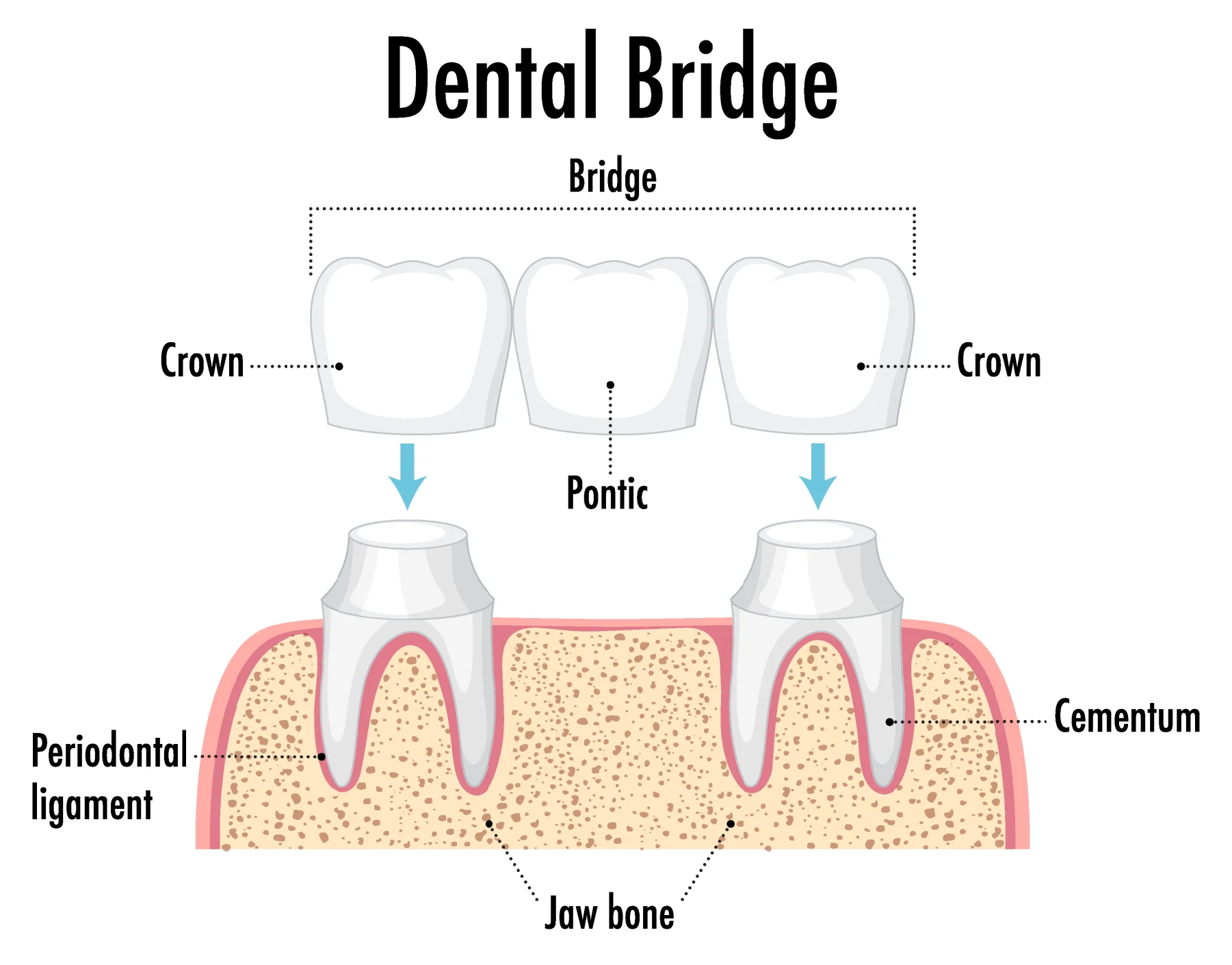 Essential Things to Know About a Dental Cantilever Bridge for Better Oral Health