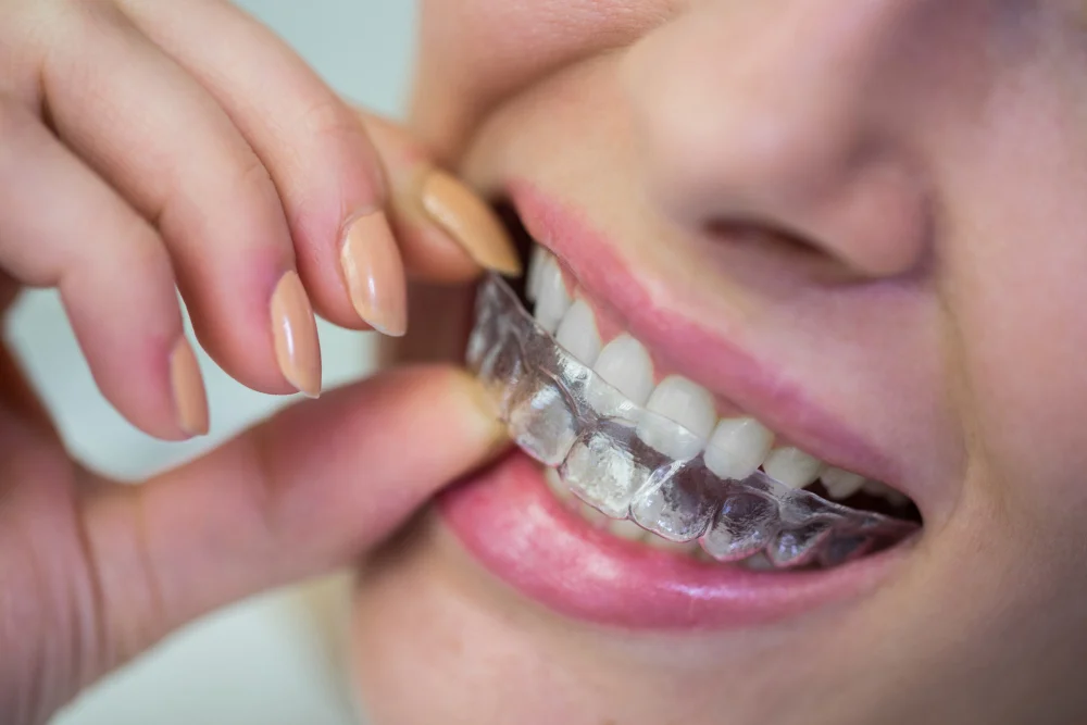 Must-Know Facts About Orthodontic Palate Expander (Complete Beginner’s Guide)