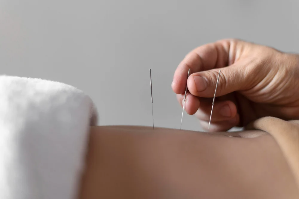 Acupuncture for Allergies: What the Evidence Says and What to Know