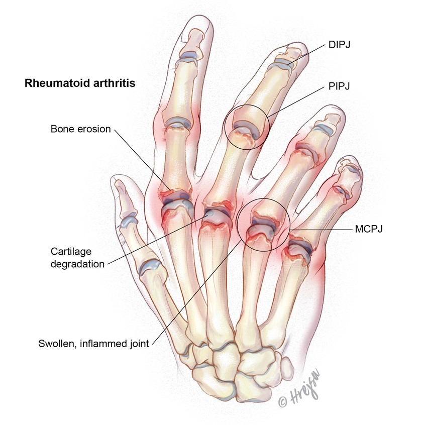 What Are the 4 Stages of Rheumatoid Arthritis? A Complete Guide