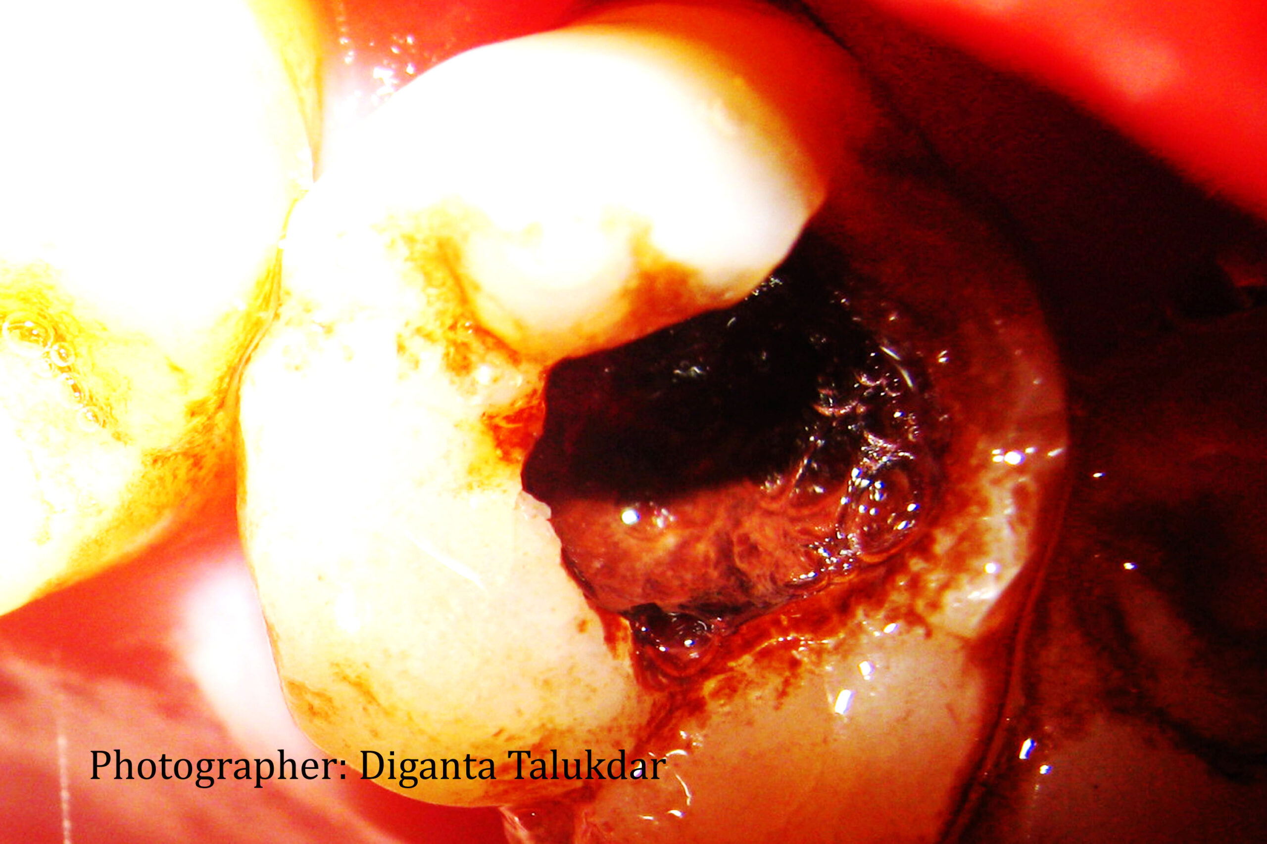 How Long Until a Tooth Infection Kills You? Risks, Timeline & Warning Signs
