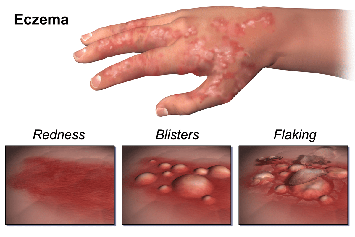 Is Eczema Contagious? Causes, Symptoms, Treatment & Prevention