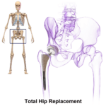 Hip replacement anatomy showing the artificial hip joint for an article about nerve damage symptoms after hip replacement