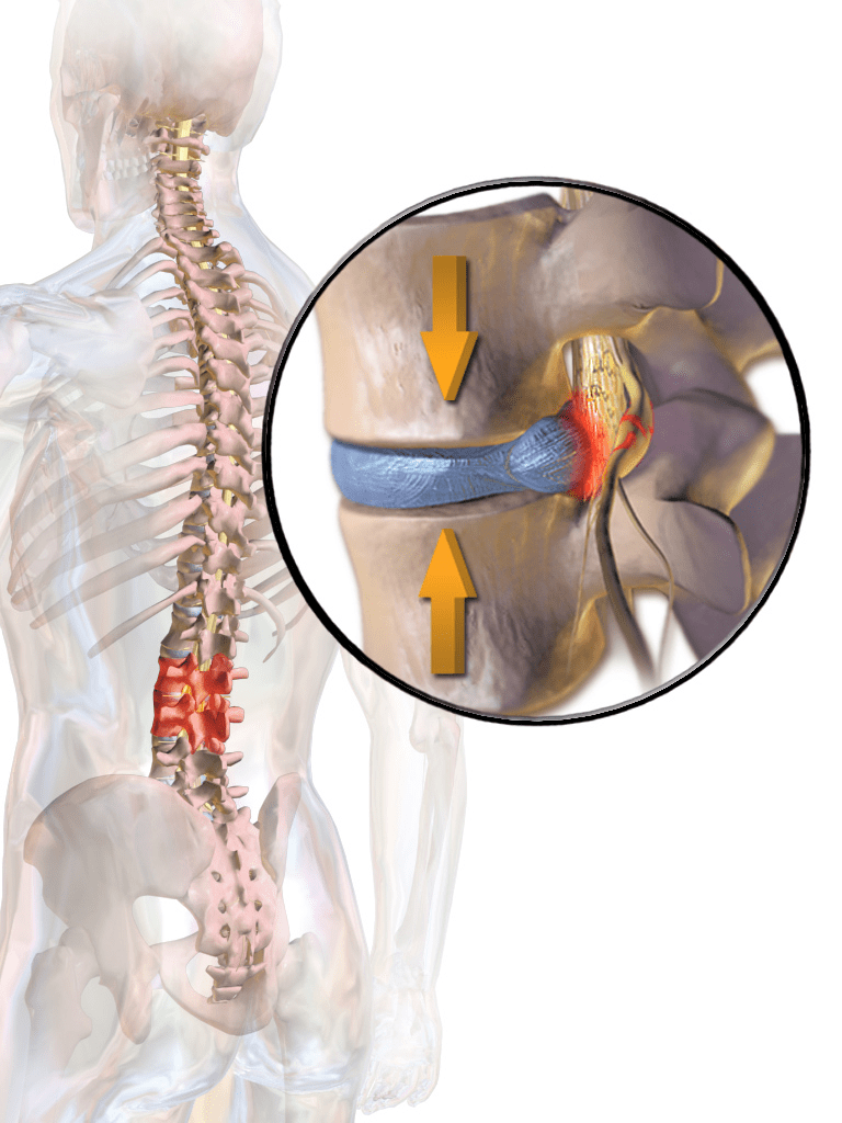 What Does a Pinched Nerve Feel Like? Symptoms, Causes & When to Get Help
